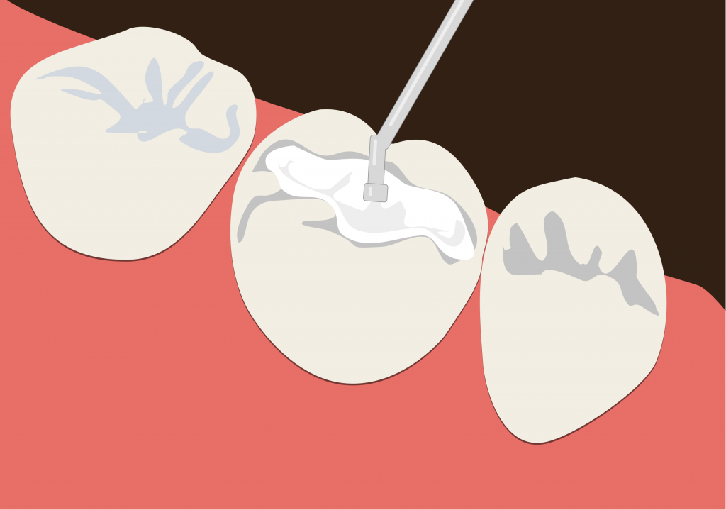 Dental Fillings Dental Fillings