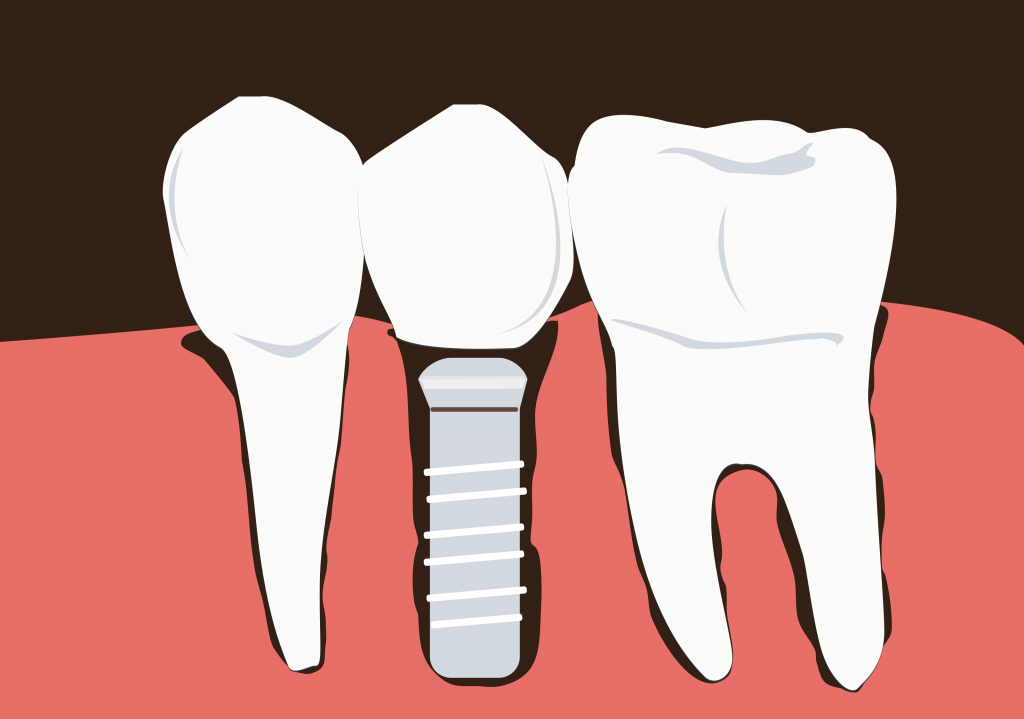 Dental Implant