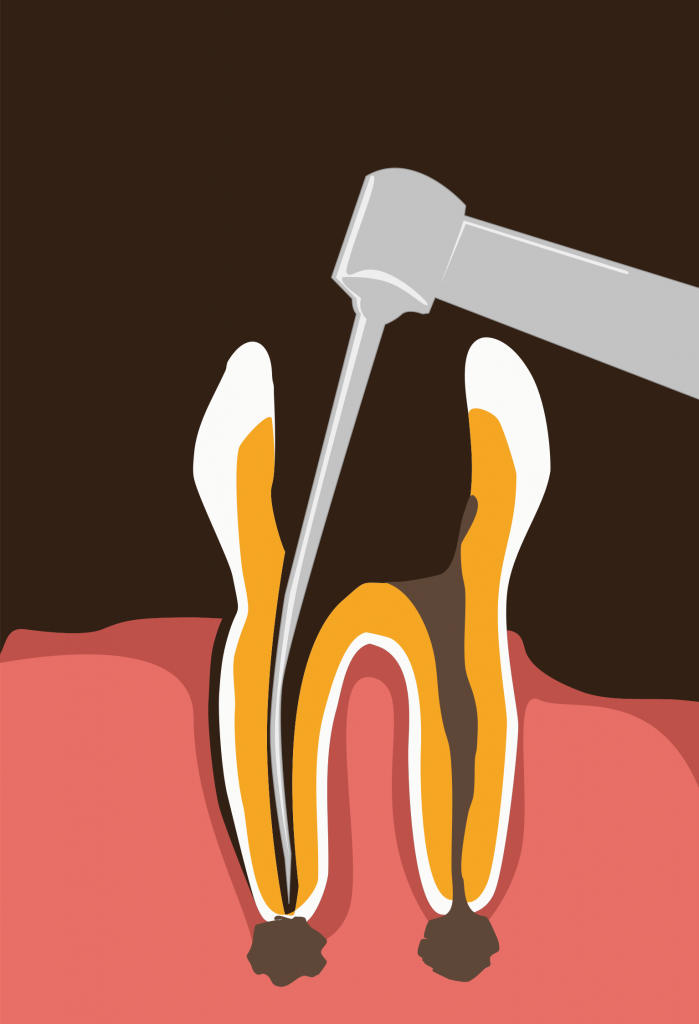 Root Canal Root Canal