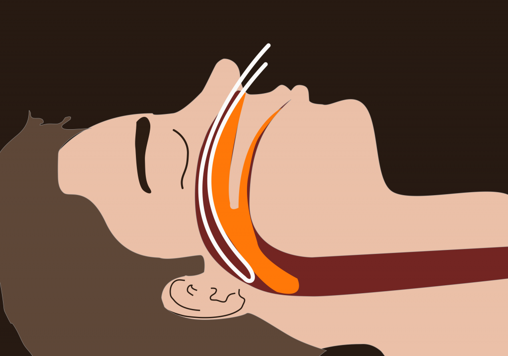 Sleep Apnea Sleep Apnea