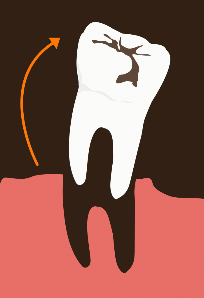Tooth Extraction and Gum Grafting Tooth Extraction and Gum Grafting