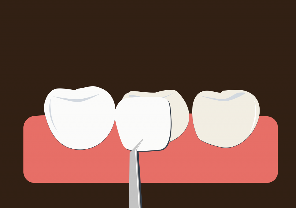 Porcelain Veneers Porcelain Veneers