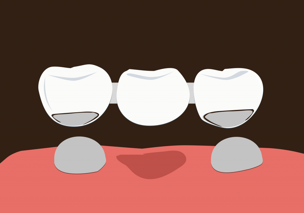 Dental Bridge Dental Bridge