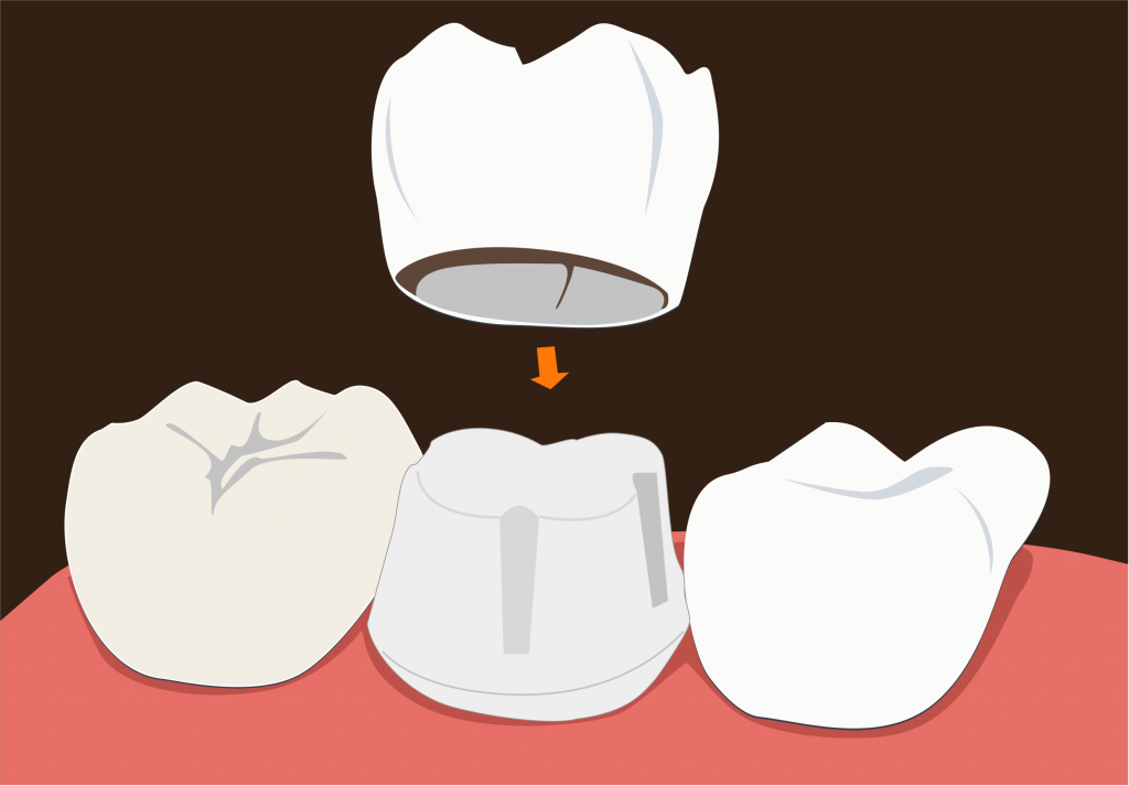Dental Crown Dental Crown