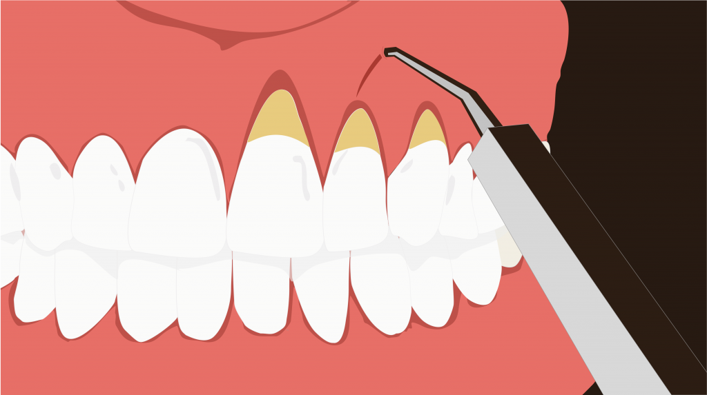 Pinhole Surgery and Gum Grafting Pinhole Surgery and Gum Grafting