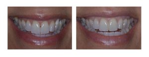 Black triangle closure with composite after whitening the teeth and replacing chalky composites on the upper left