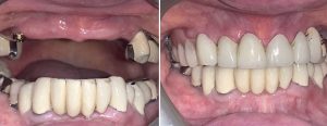 old large upper bridge and old lower bridges replaced with upper snap-on denture and new crown/bridge on the lower teeth