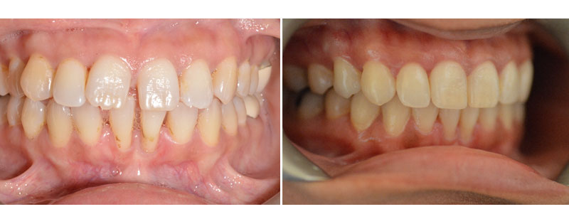 Invisalign