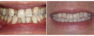 Invisalign