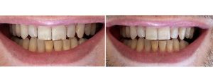 chipped edges of the front teeth -- reshaping /enameloplasty
