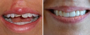 Trauma case - Veneers on two front teeth