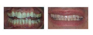 Invisalign + change of old front crown