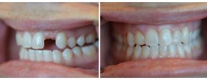 Maryland Bridge for missing front tooth