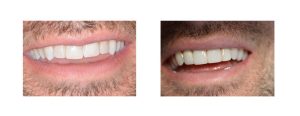 reshaping of canines and 4 front veneers