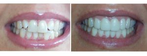 veneers on 4 top front teeth and 2 bottom front teeth to correct malalignment for something who didn't want to do Invisalign