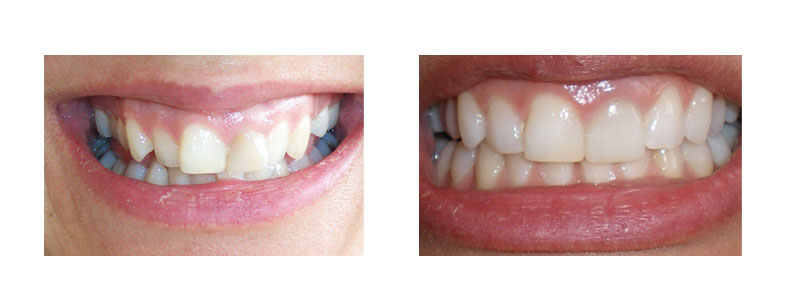 Invisalign + one front veneer