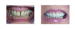 old crowns and gummy smile transformed with gum recontouring (esthetic crown lengthening) + new crowns on top teeth