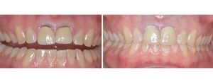 old crowns replacement