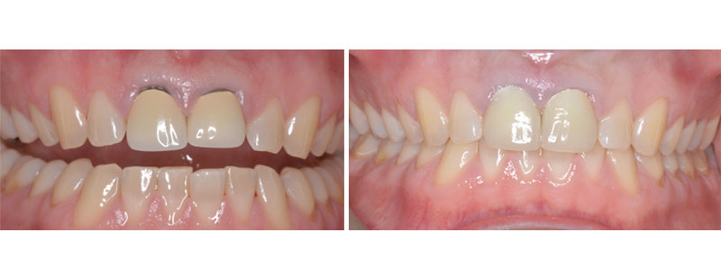 old crowns replacement