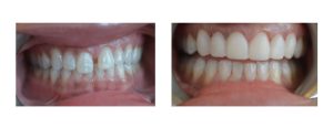 no ortho, closing gap with veneers from canine to canine on the top