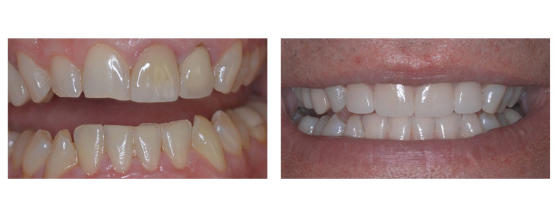 old veneer plus chipped teeth fixed with 4 front veneers + whitening