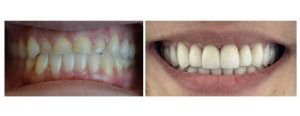 before picture is of ortho-completed case for a patient (skeletal class III - larger lower jaw than the upper jaw with an edge to edge bite in the front)--> transformed into a class I presentation (normalized teeth presentation) done by opening the bite on the upper jaw -- crowns & veneers on all the upper teeth.