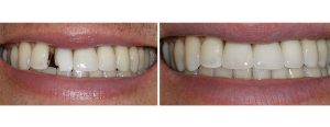 fractured old crown replacement