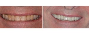 smile makeover - old fillings and pt unhappy with the size and shape of the teeth throughout---> full upper arch reconstruction with crowns/veneers along with whitening the lower teeth