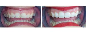 uneven gumline gum reshaping + 4 front veneers since pt was displeased with the shape/size of her front teeth