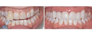 old fillings on front two teeth + natural spotting on the teeth that patient did not like --> whitening + 6 front veneers