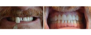 gap closure + evening the size of the top front teeth with 4 front veneers and whitening