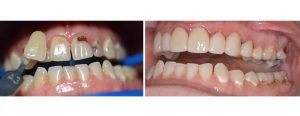 extensive caries and misshapen teeth -- pt wanted to address the front ones only due to finances without any Invisalign -> whitening + 6 front veneers