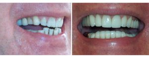 malalingment correction for a patient uninterested in orthodontics -- done with veneers/crowns on top and bottom
