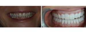 old short veneers/crowns replaced with crowns/veneers after opening the bite