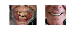 extensive decay and missing bottom teeth -> addressed with extractions, crowns/bridges and a partial on the lower