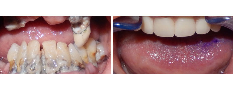 extensive caries due to poor hygiene --- extractions and denture on upper shown here