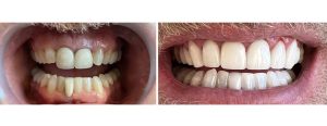 gummy smile, uneven teeth with large front crowns --> patient did not want to have Invisalign -> gum recontouring (esthetic crown lengthening) + 10 crowns/veneers on upper teeth and 1 crown on the lower after whitening the lowers