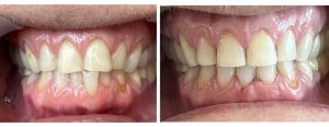 crowding corrected with extraction of a lower front tooth + Invislaign during the first step second step: whitening at home + black triangle closure with composite and Bioclear + shaping of the upper teeth chairside