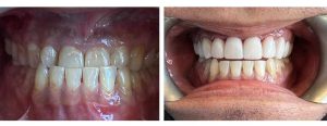 full upper arch reconstruction for a bite collapse with crowns only