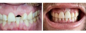Patient missing front tooth, crowded lower front -- did Invisalign + implant #9