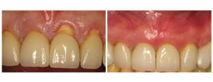 Pinhole gum grafting procedure