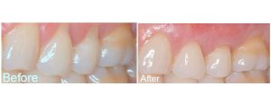 Pinhole gum grafting procedure