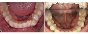 Invisalign