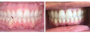Invisalign