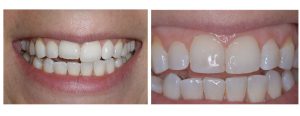 Uneven Teeth - Bonding