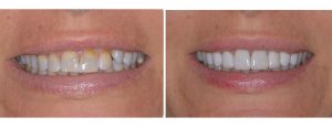 significant erosion from eating disorder along with lack of alignment --- crowns and veneers done on upper teeth to address those without any ortho