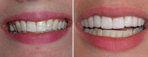 Patient with fluorosis - Veneers