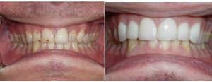 old single crown and old fillings -- pt wanted uniform white smile with more prominent teeth -- new smile line with 1 crown and 5 veneers