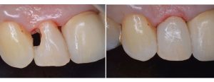 big decay on top front tooth - restored with composite filling