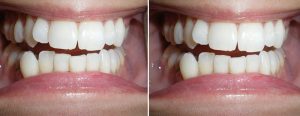 misalignment and chipping -- Invisalign + tooth reshaping